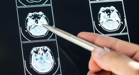 Imagem do post Maio Cinza: alerta sobre importância da atenção aos sintomas para diagnóstico precoce dos tumores cerebrais