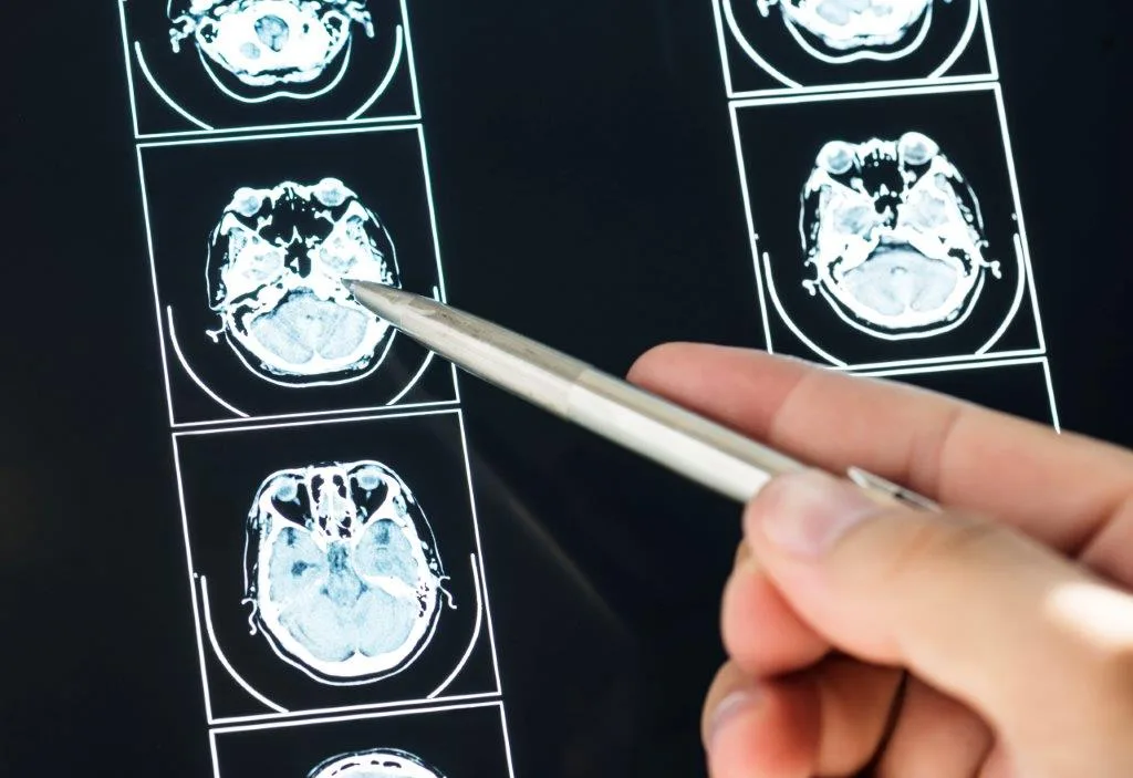 Maio Cinza: alerta sobre importância da atenção aos sintomas para diagnóstico precoce dos tumores cerebrais