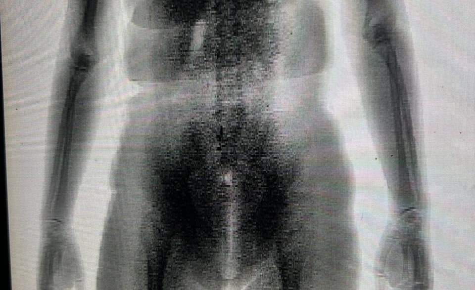 BodyScan flagra mulher com drogas no Conjunto Penal de Juazeiro